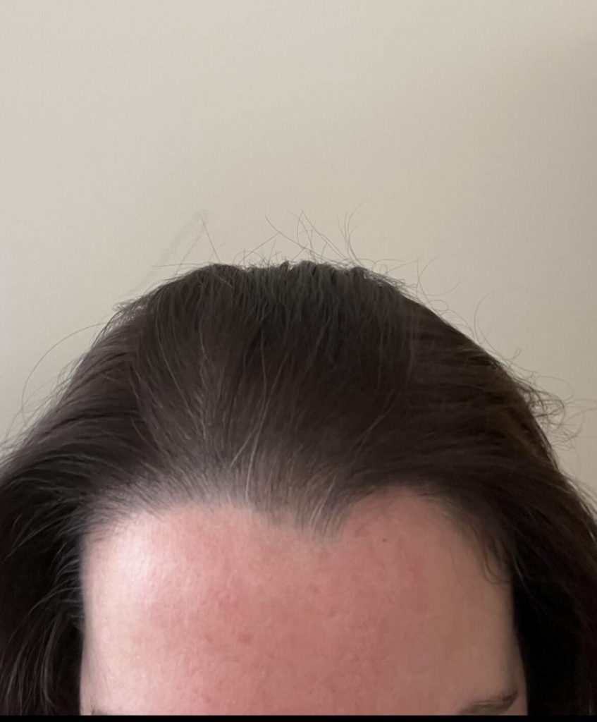 scalp micropigmentation for hair loss