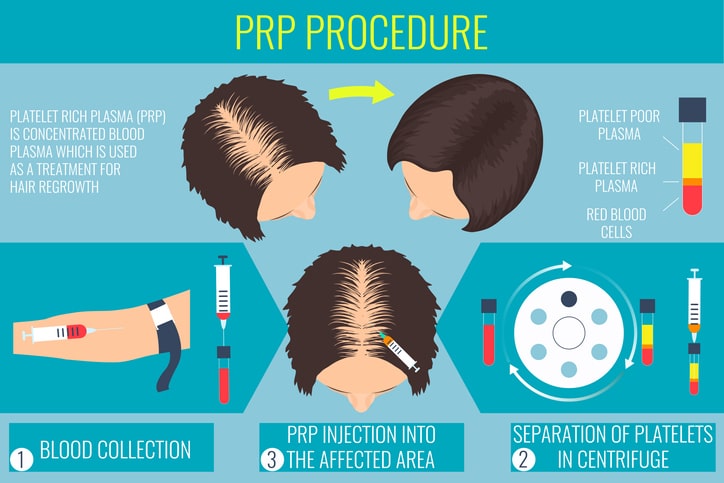 prp procedure for hair thinning